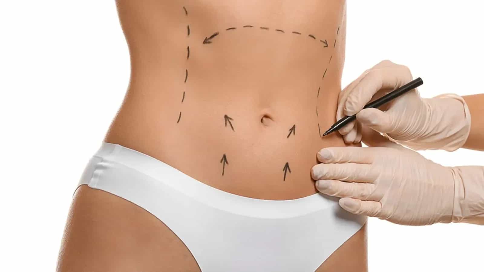 Abdominoplastika