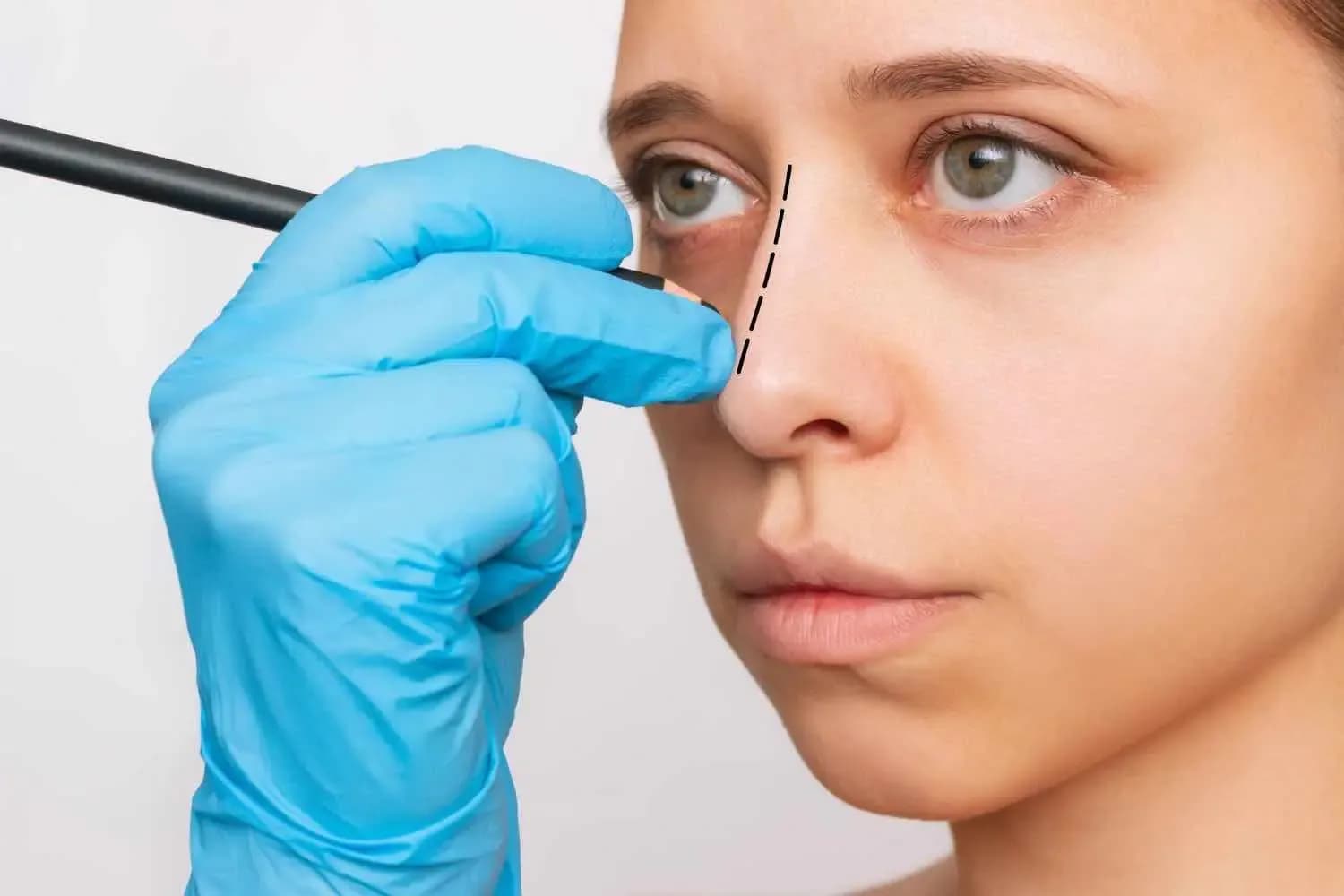 Rinoplastika