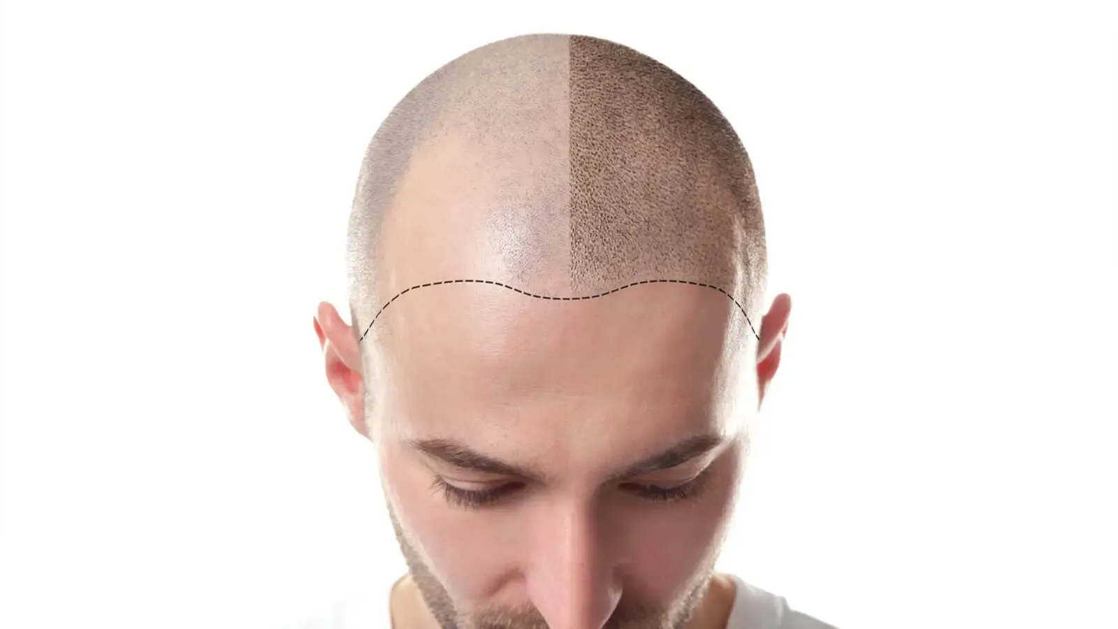 Soch transplantatsiyasi